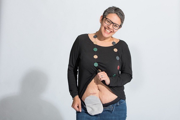 Sam is smiling at the camera, showing her ostomy bag.