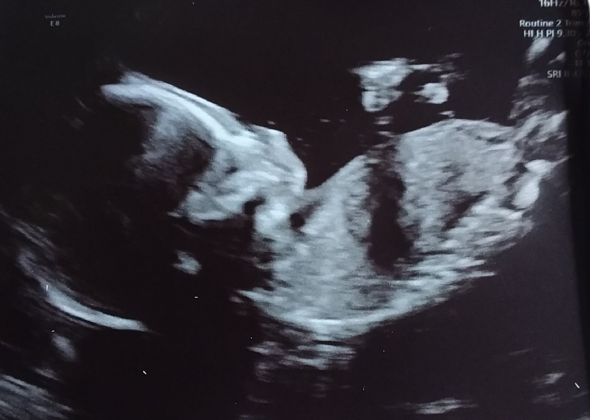 Our second scan picture of little Avenger- bit bigger!